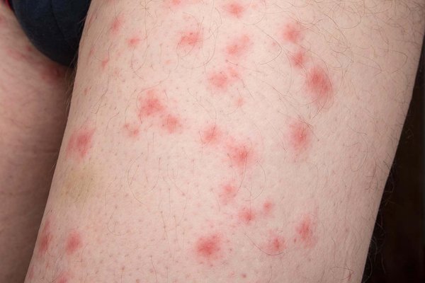 Bed Bug Bites on Skin